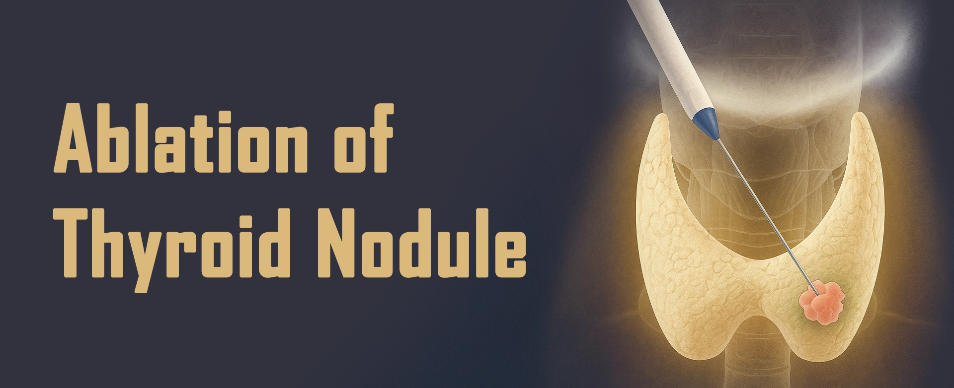 Ablation of Thyroid Nodule