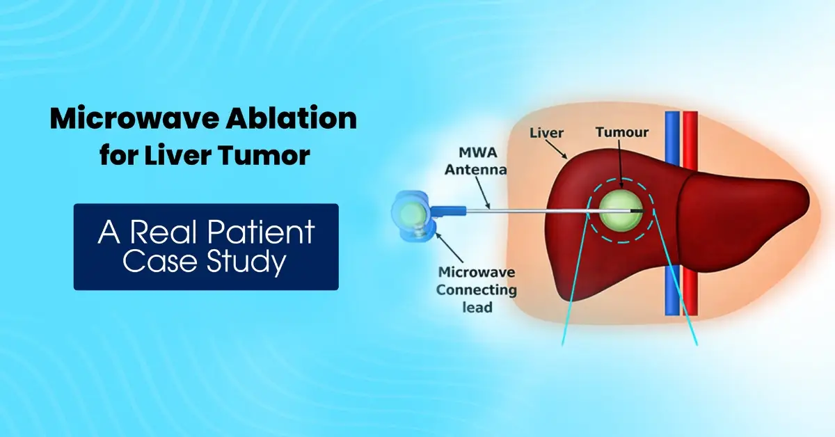microwave-ablation-for-liver-metastasis