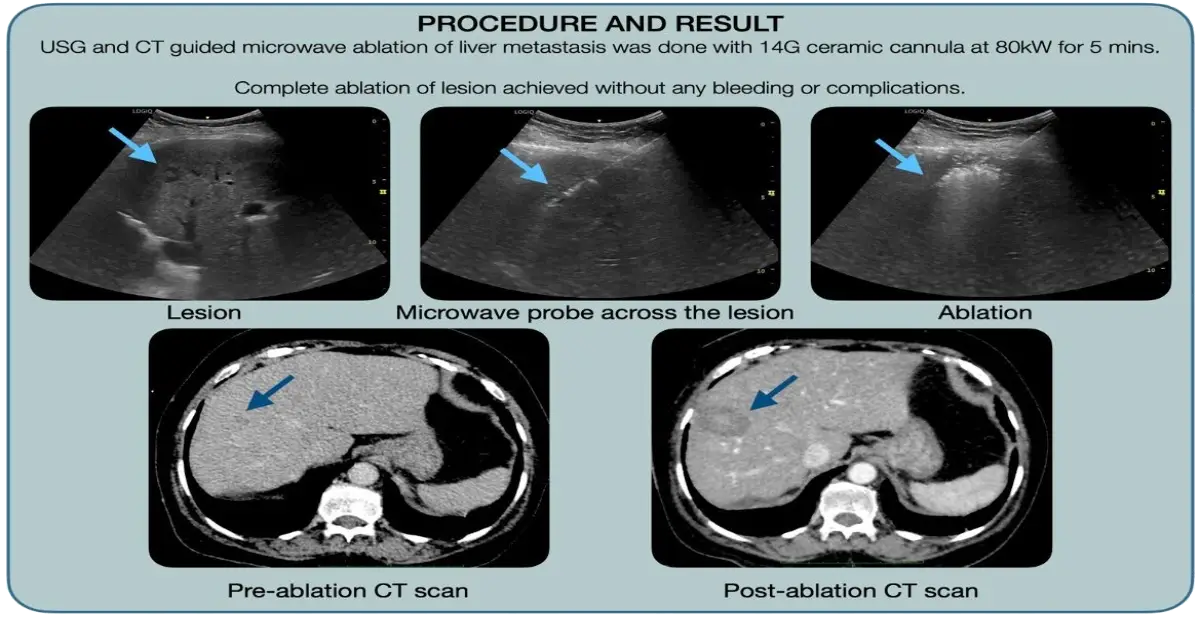 microwave-ablation-for-liver-metastasis