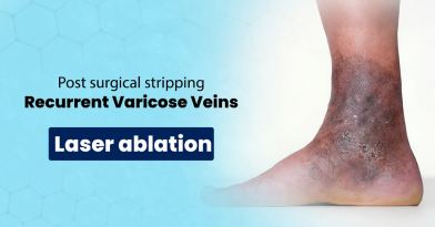 Post-Surgical Stripping: Treatment of Recurrent Varicose Vein Ulcer