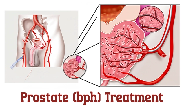 prostate-procedures bph treatment