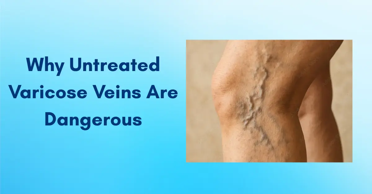 risks-of-untreated-varicose-veins