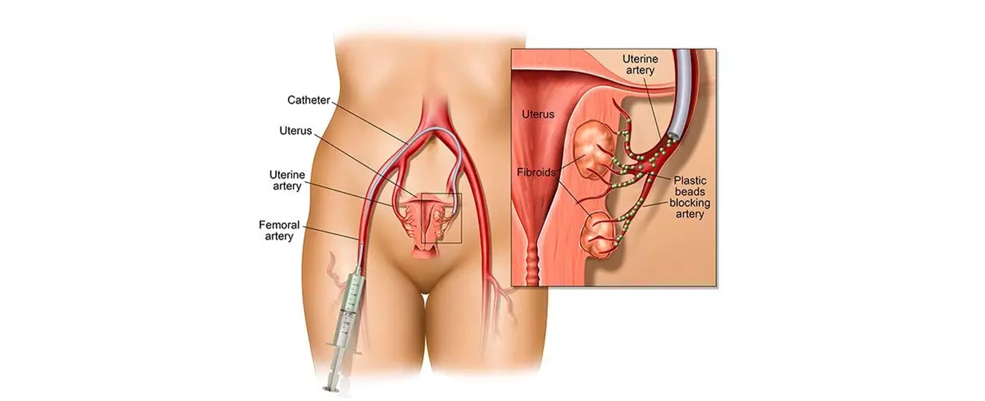 UAE for Fibroids & Adenomyosis: Effective Treatment