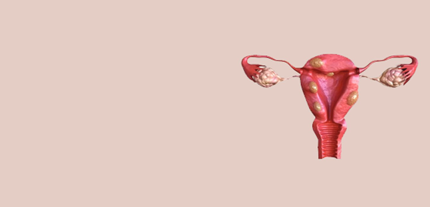 Uterine Fibroid Embolisation in Ahmedabad