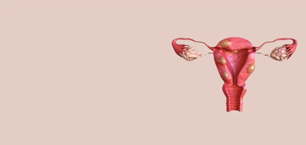 Uterine Fibroid Embolisation in Ahmedabad