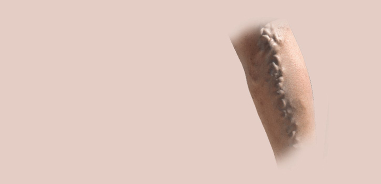 Varicose Veins Treatment in Ahmedabad