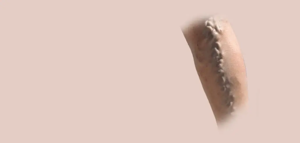 Varicose Veins Treatment in Ahmedabad