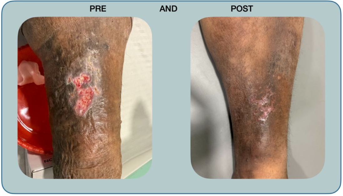 visible-improvement-in-the-ulcer