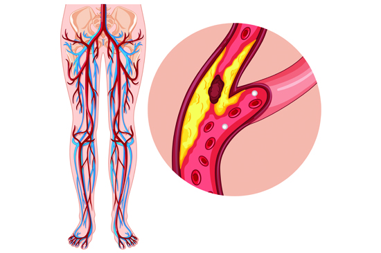 Peripheral Artery Disease