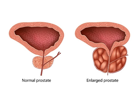 Prostate
