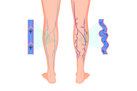 Venous Disease
